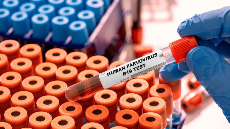 Bērnudārzos izplatās parvovīruss – dažviet lūdz bērnus nevest Bērnudārzos izplatās parvovīruss – dažviet lūdz bērnus nevest