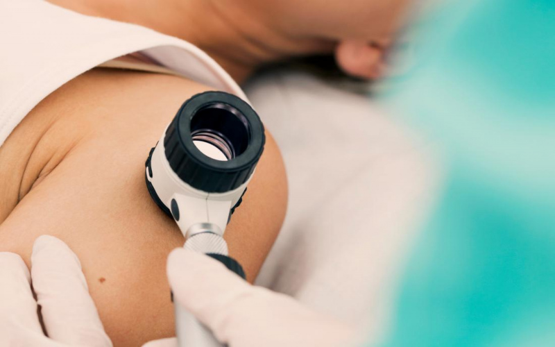 Agrīnai melanomas diagnostikai vairākās pilsētās būs pieejamas bezmaksas vizītes ādas veidojumu pārbaudei Agrīnai melanomas diagnostikai vairākās pilsētās būs pieejamas bezmaksas vizītes ādas veidojumu pārbaudei
